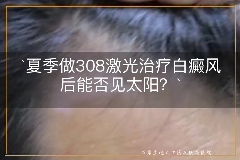 `夏季做308激光治疗白癜风后能否见太阳？`