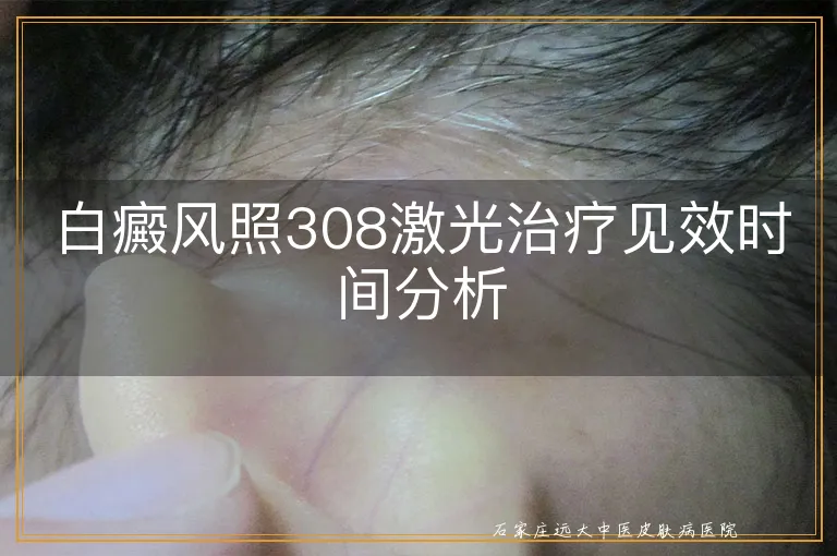 白癜风照308激光治疗见效时间分析