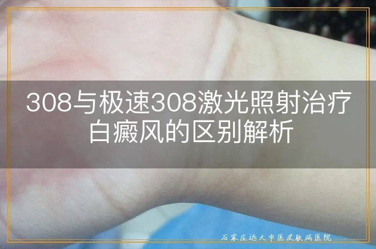 308与极速308激光照射治疗白癜风的区别解析