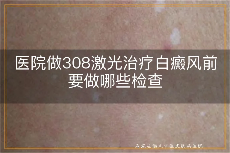 医院做308激光治疗白癜风前要做哪些检查