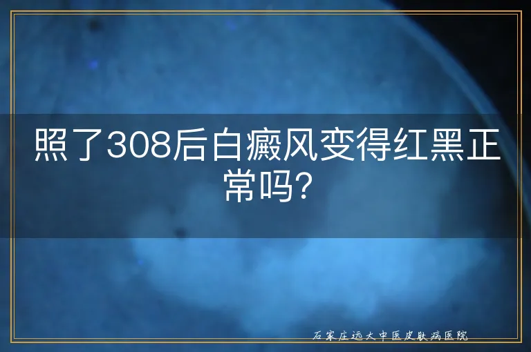 照了308后白癜风变得红黑正常吗？