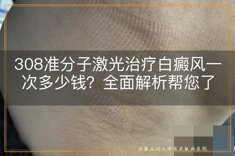 308准分子激光治疗白癜风一次多少钱？全面解析帮您了解