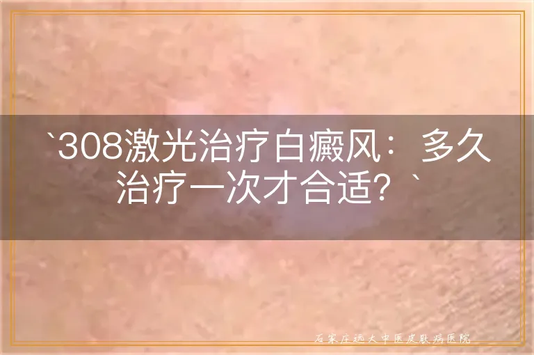 `308激光治疗白癜风：多久治疗一次才合适？`