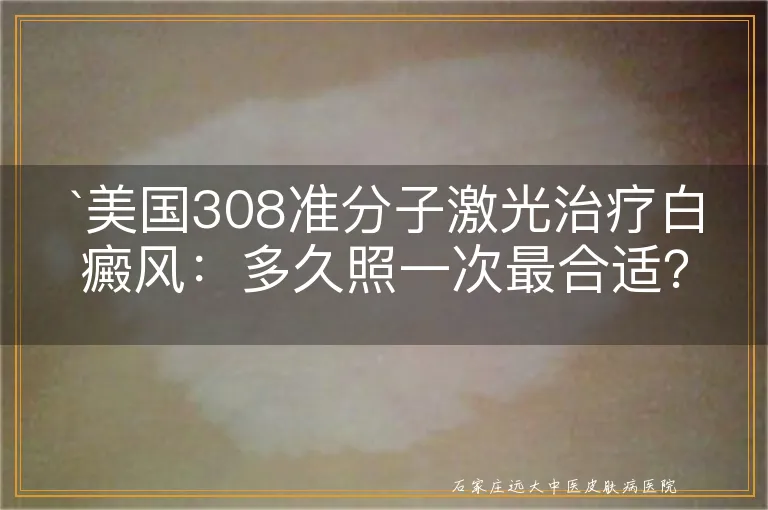 `美国308准分子激光治疗白癜风：多久照一次最合适？`