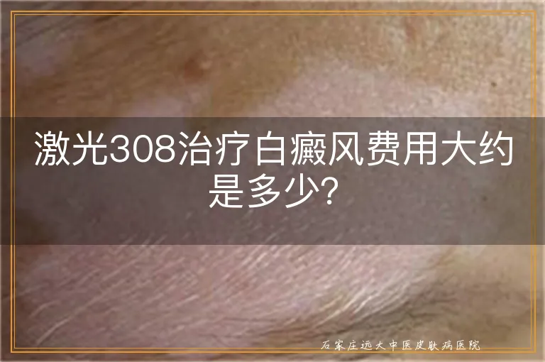 激光308治疗白癜风费用大约是多少？