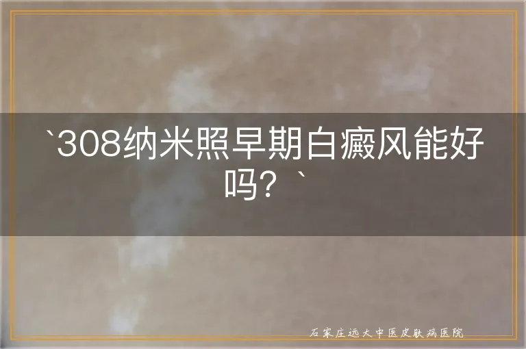 `308纳米照早期白癜风能好吗？`