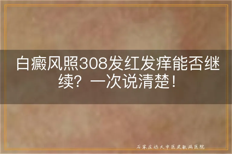 白癜风照308发红发痒能否继续？一次说清楚！