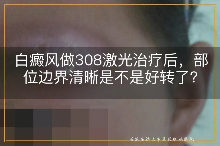 白癜风做308激光治疗后，部位边界清晰是不是好转了？