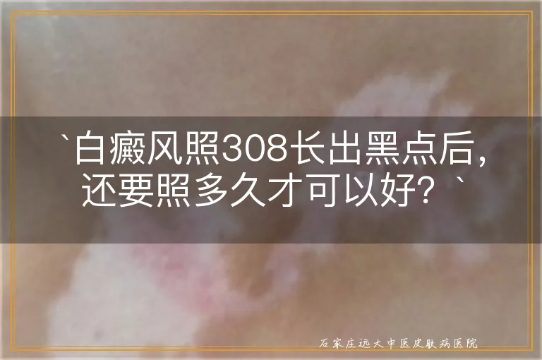 `白癜风照308长出黑点后，还要照多久才可以好？`