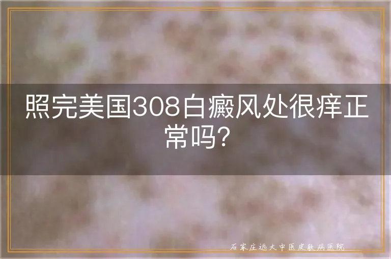 照完美国308白癜风处很痒正常吗？