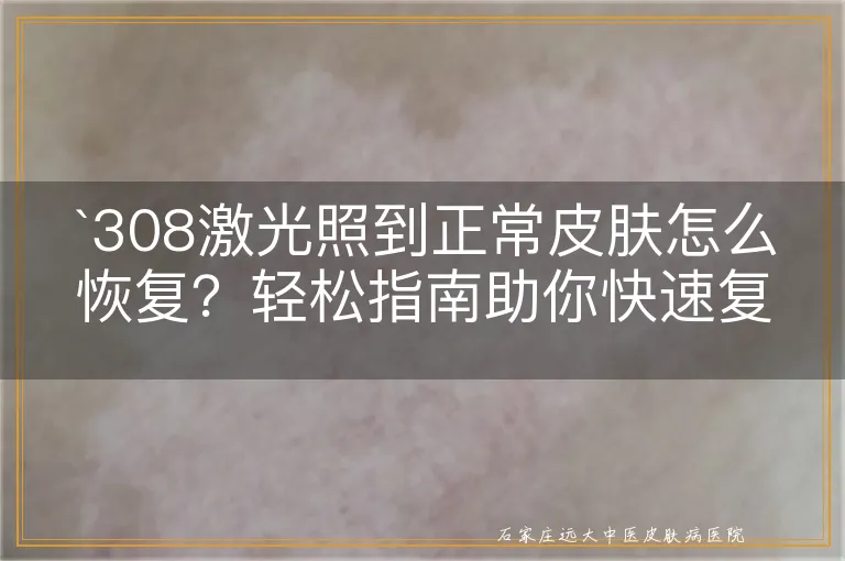 `308激光照到正常皮肤怎么恢复？轻松指南助你快速复原`