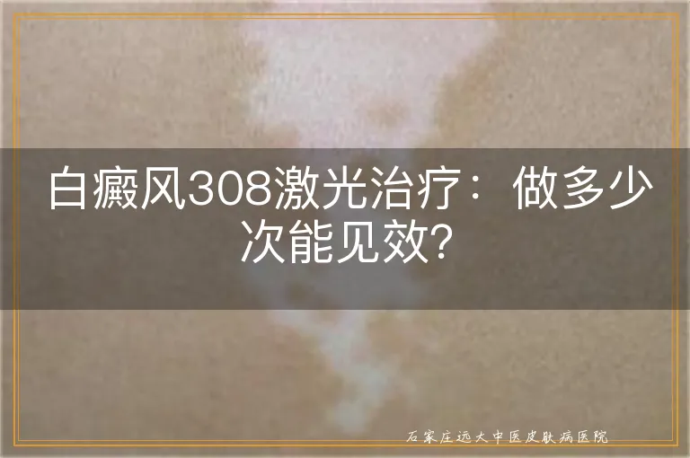 白癜风308激光治疗：做多少次能见效？