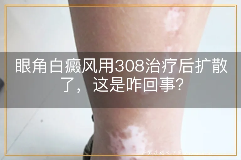 眼角白癜风用308治疗后扩散了，这是咋回事？