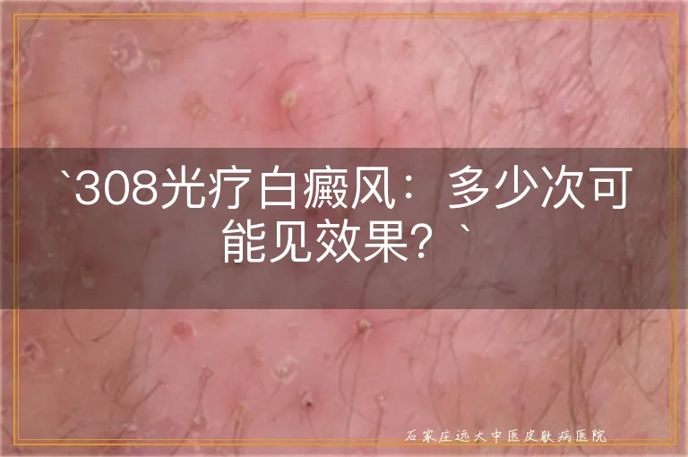 `308光疗白癜风：多少次可能见效果？`