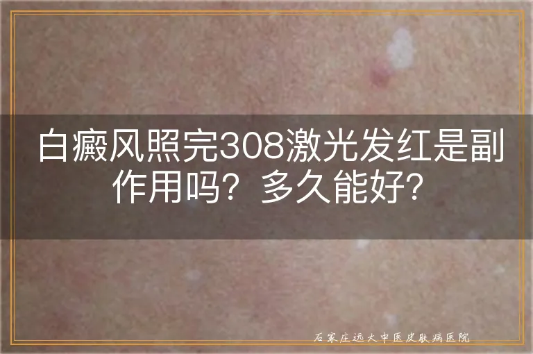 白癜风照完308激光发红是副作用吗？多久能好？