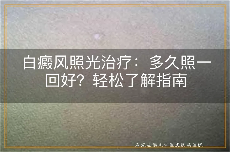 白癜风照光治疗：多久照一回好？轻松了解指南