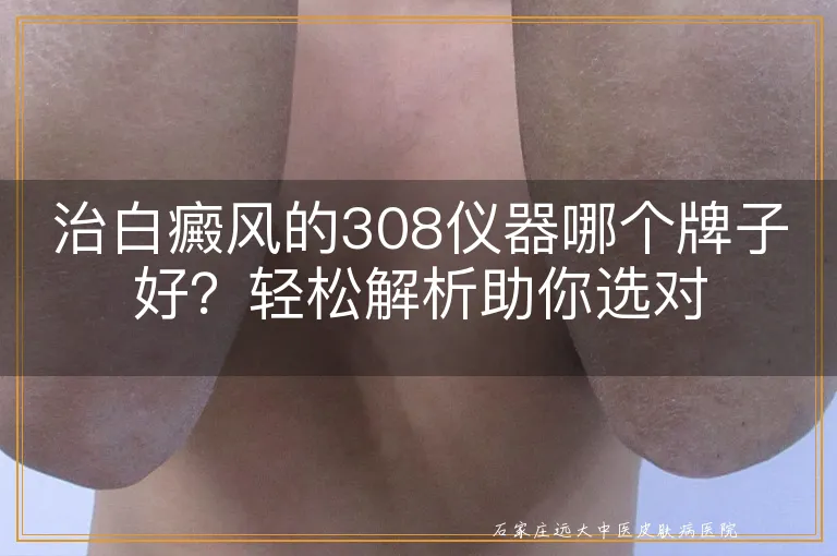 治白癜风的308仪器哪个牌子好？轻松解析助你选对