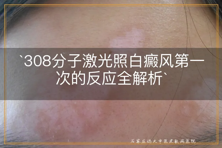 `308分子激光照白癜风第一次的反应全解析`