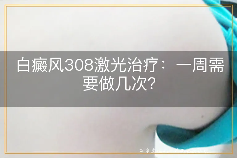 白癜风308激光治疗：一周需要做几次？