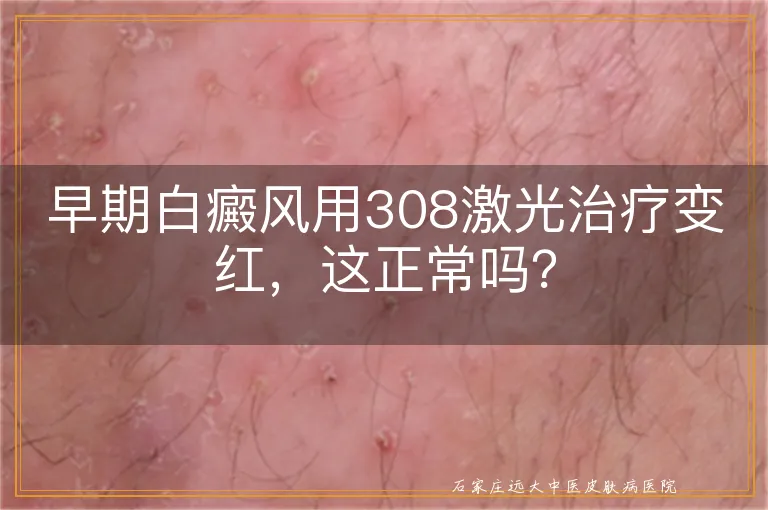 早期白癜风用308激光治疗变红，这正常吗？