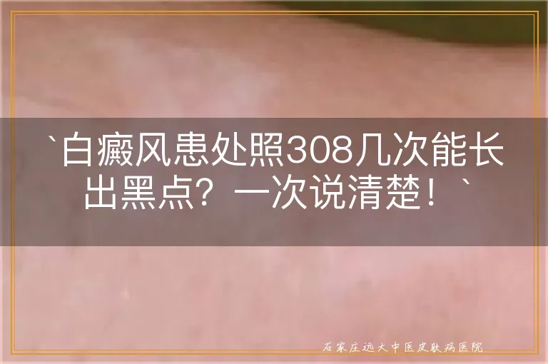 `白癜风患处照308几次能长出黑点？一次说清楚！`