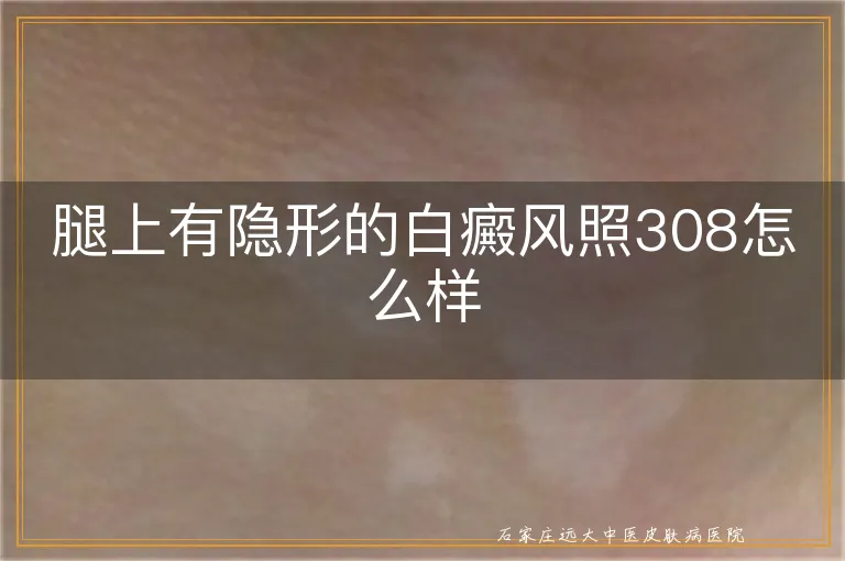 腿上有隐形的白癜风照308怎么样