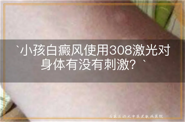 `小孩白癜风使用308激光对身体有没有刺激？`