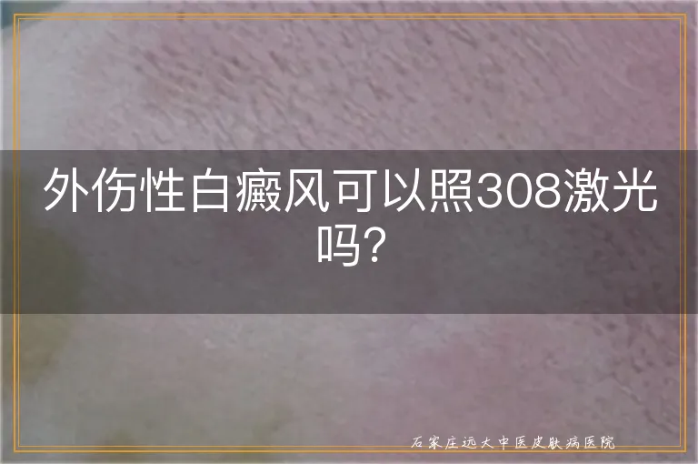 外伤性白癜风可以照308激光吗？