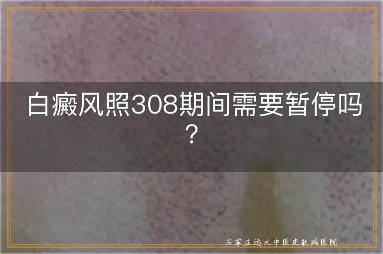 白癜风照308期间需要暂停吗？