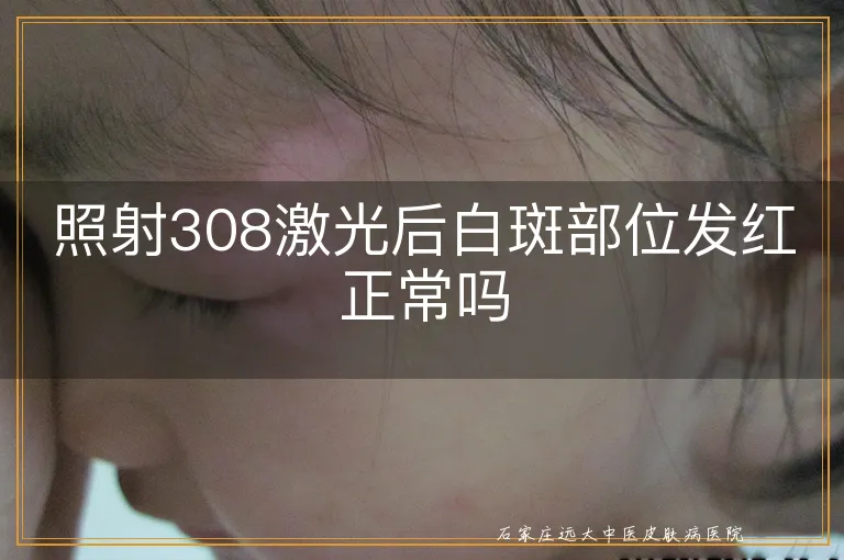 照射308激光后白斑部位发红正常吗