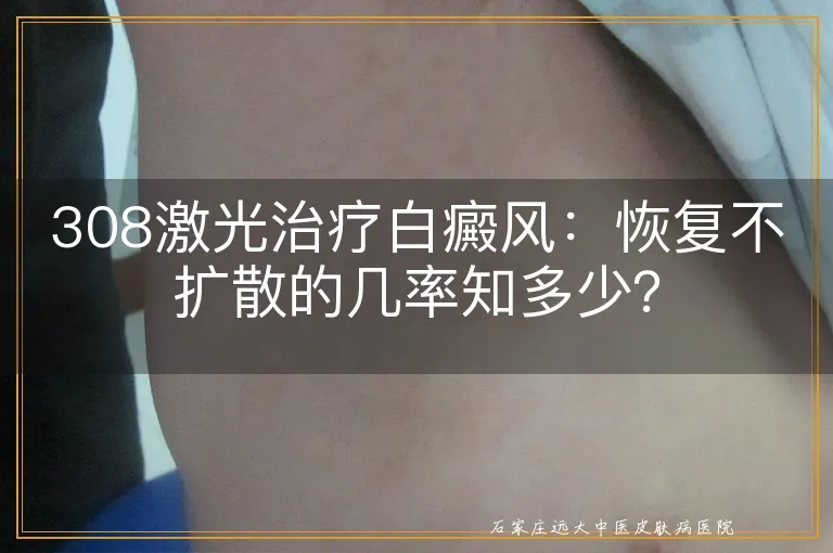 308激光治疗白癜风：恢复不扩散的几率知多少？