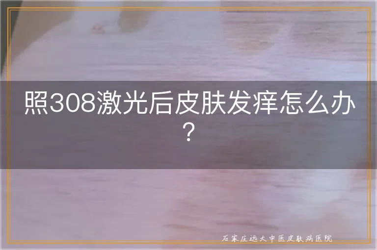 照308激光后皮肤发痒怎么办？