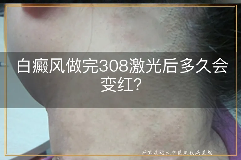 白癜风做完308激光后多久会变红？