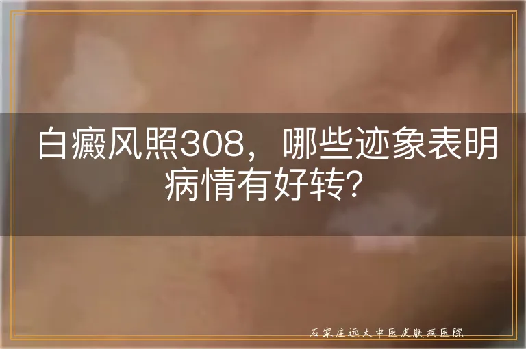 白癜风照308，哪些迹象表明病情有好转？