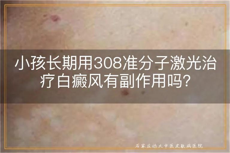 小孩长期用308准分子激光治疗白癜风有副作用吗？