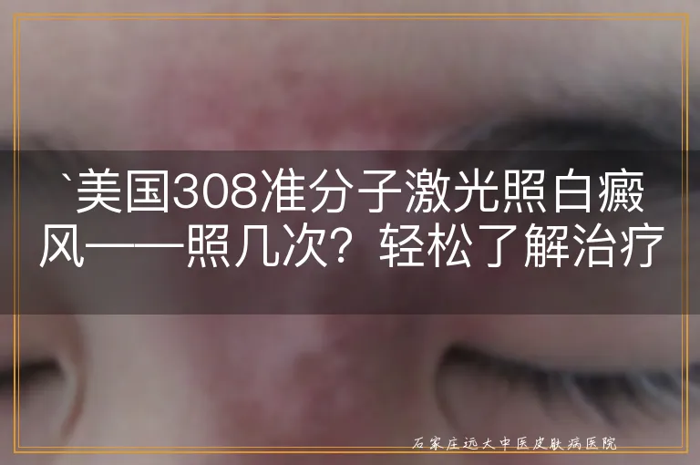 `美国308准分子激光照白癜风——照几次？轻松了解治疗频率`