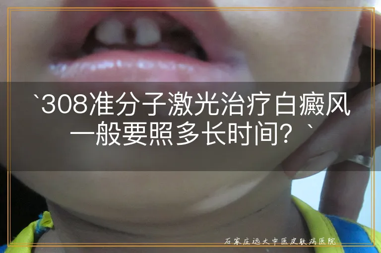 `308准分子激光治疗白癜风一般要照多长时间？`