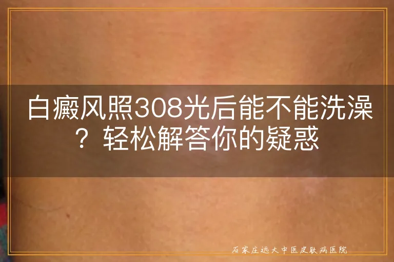 白癜风照308光后能不能洗澡？轻松解答你的疑惑