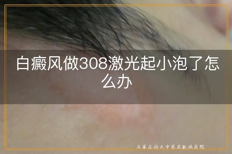 白癜风做308激光起小泡了怎么办