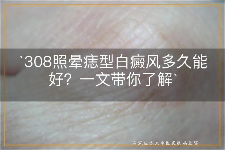 `308照晕痣型白癜风多久能好？一文带你了解`