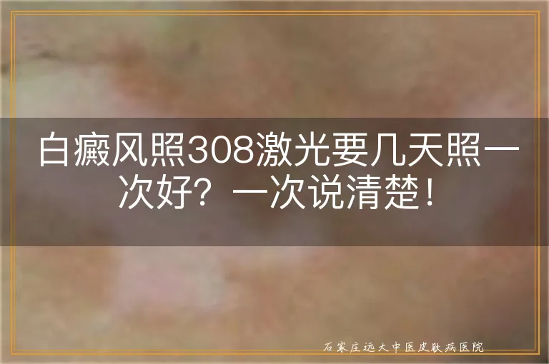 白癜风照308激光要几天照一次好？一次说清楚！