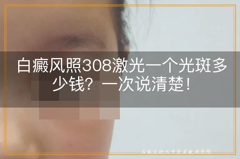 白癜风照308激光一个光斑多少钱？一次说清楚！