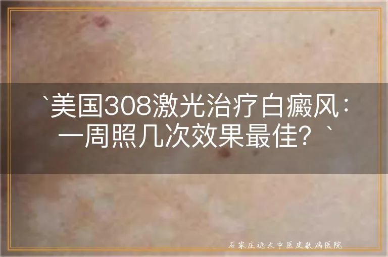 `美国308激光治疗白癜风：一周照几次效果最佳？`