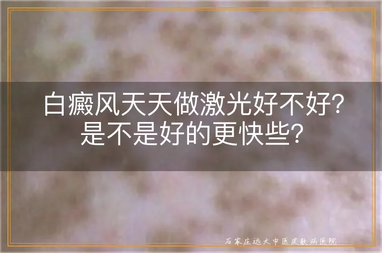 白癜风天天做激光好不好？是不是好的更快些？