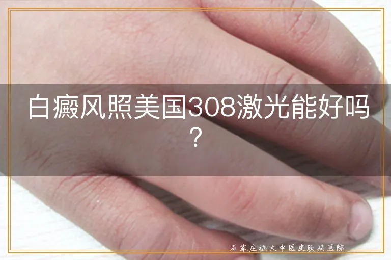 白癜风照美国308激光能好吗？