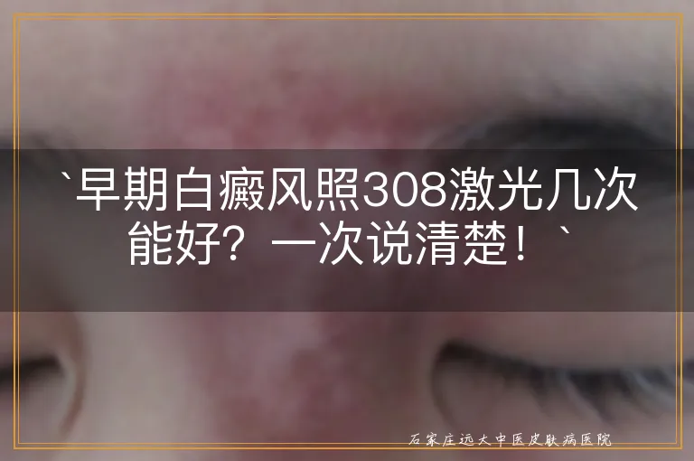 `早期白癜风照308激光几次能好？一次说清楚！`