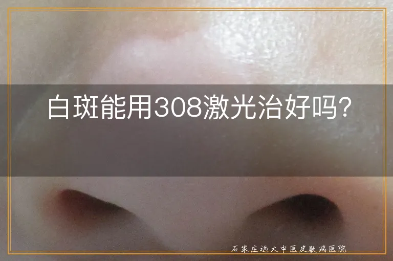 白斑能用308激光治好吗？