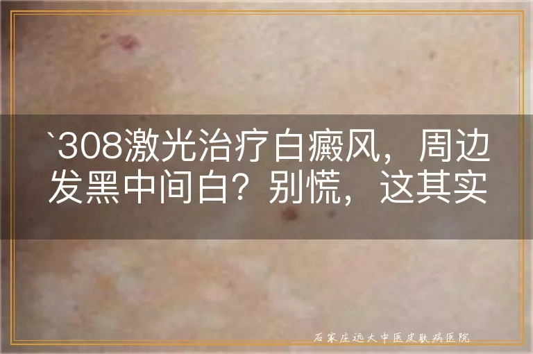 308激光治疗白癜风，周边发黑中间白？别慌，这其实是好转的信号！