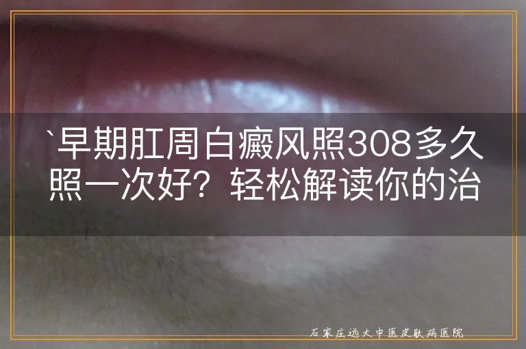 `早期肛周白癜风照308多久照一次好？轻松解读你的治疗疑惑`