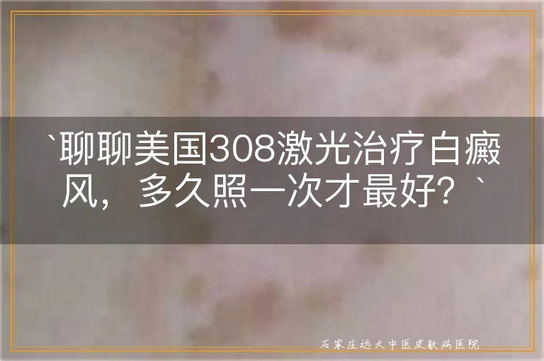 `聊聊美国308激光治疗白癜风，多久照一次才最好？`